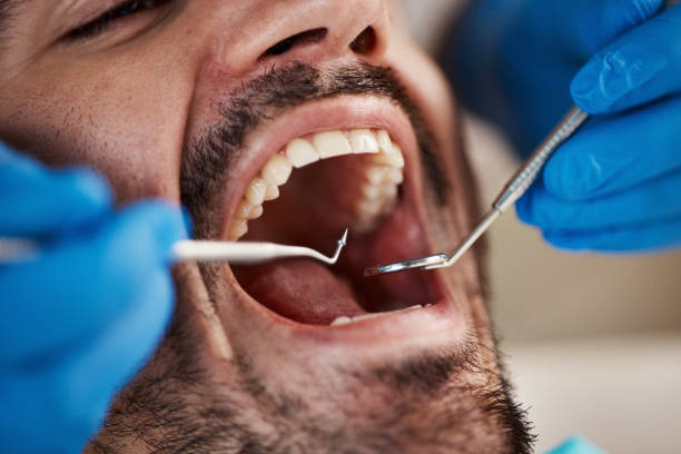 Best Emergency Root Canal Treatment in Slidell, LA